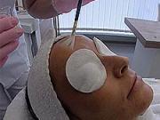 Chemický peeling - Dermatologie 