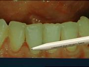 Jak vzniká zánět dásní, paradentóza a zubní  kaz - ustní hygiena  2