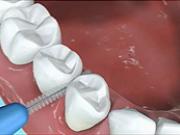 Čistění chrupu - jak si správně čistit zuby - dentálni hygiena 3