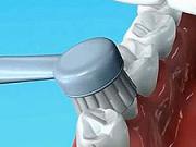Elektrický zubní kartáček - Jak používat elektrický zubní kartáček - dentálni hygiena 7